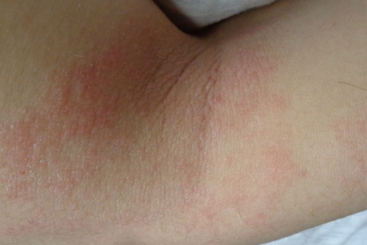 La piel atópica, una afección muy común que tiene solución