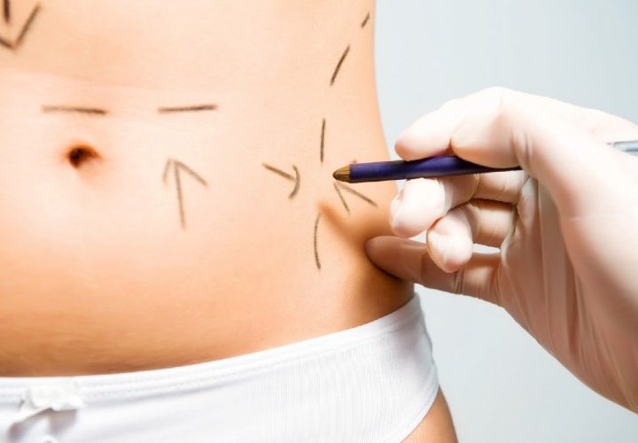 Cirugía estética después de la pérdida masiva de peso