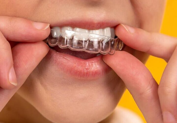 ¿Cuáles son las ventajas de la ortodoncia invisible?