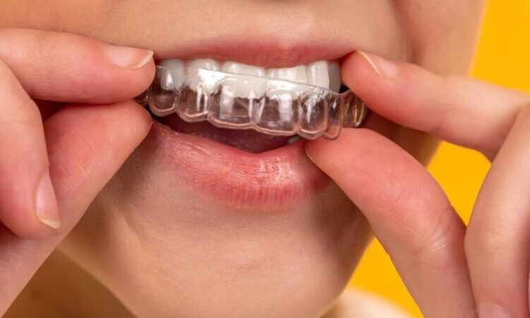 ¿Cuáles son las ventajas de la ortodoncia invisible?